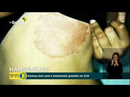 Hanseníase: doença tem cura e tratamento pelo SUS